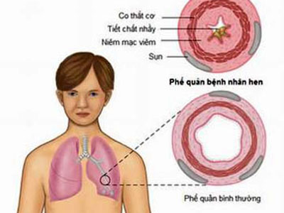 thuốc trị hen phế quản ở trẻ em